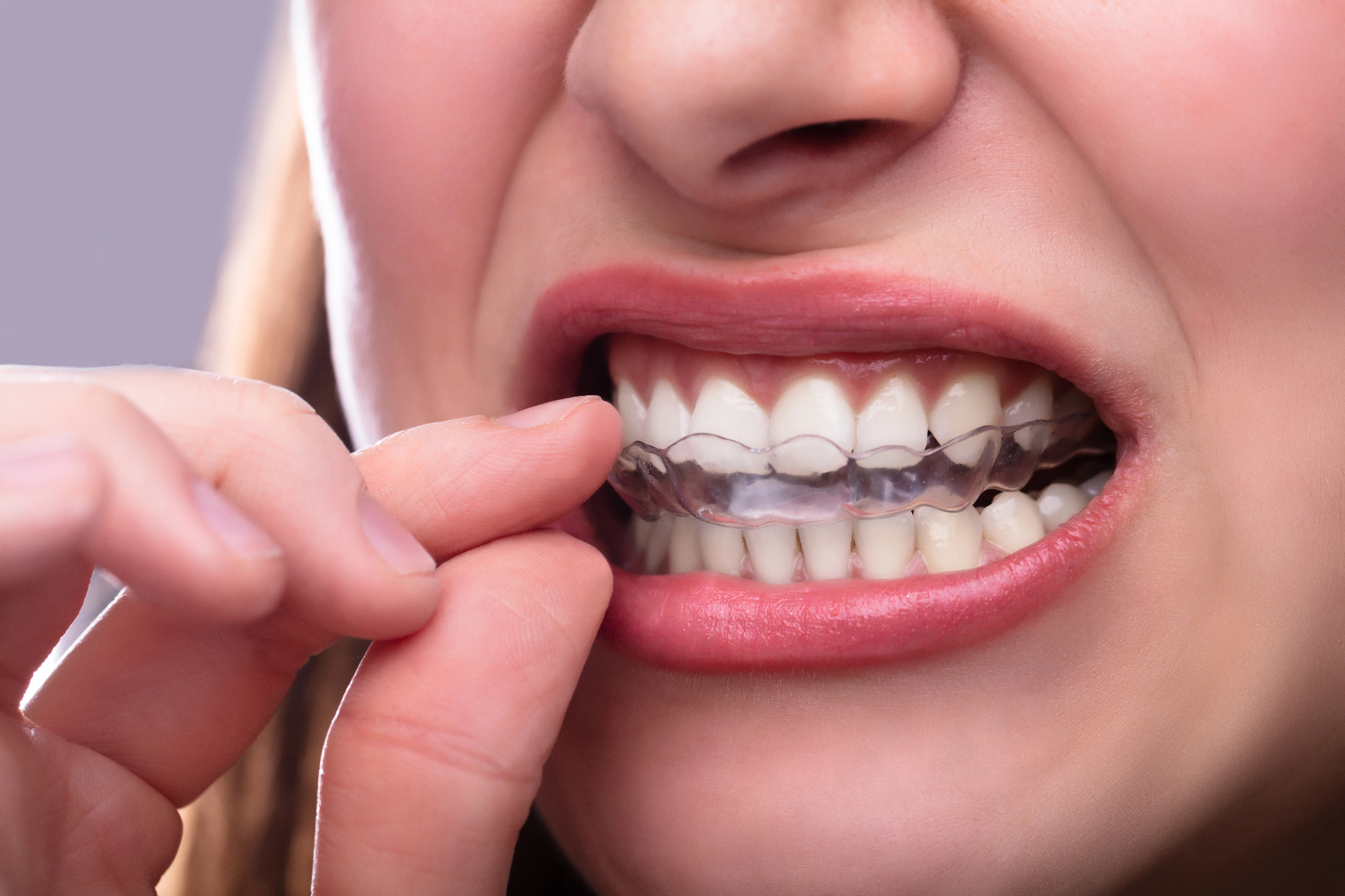 Ali vpliva invisalign cena na nakup